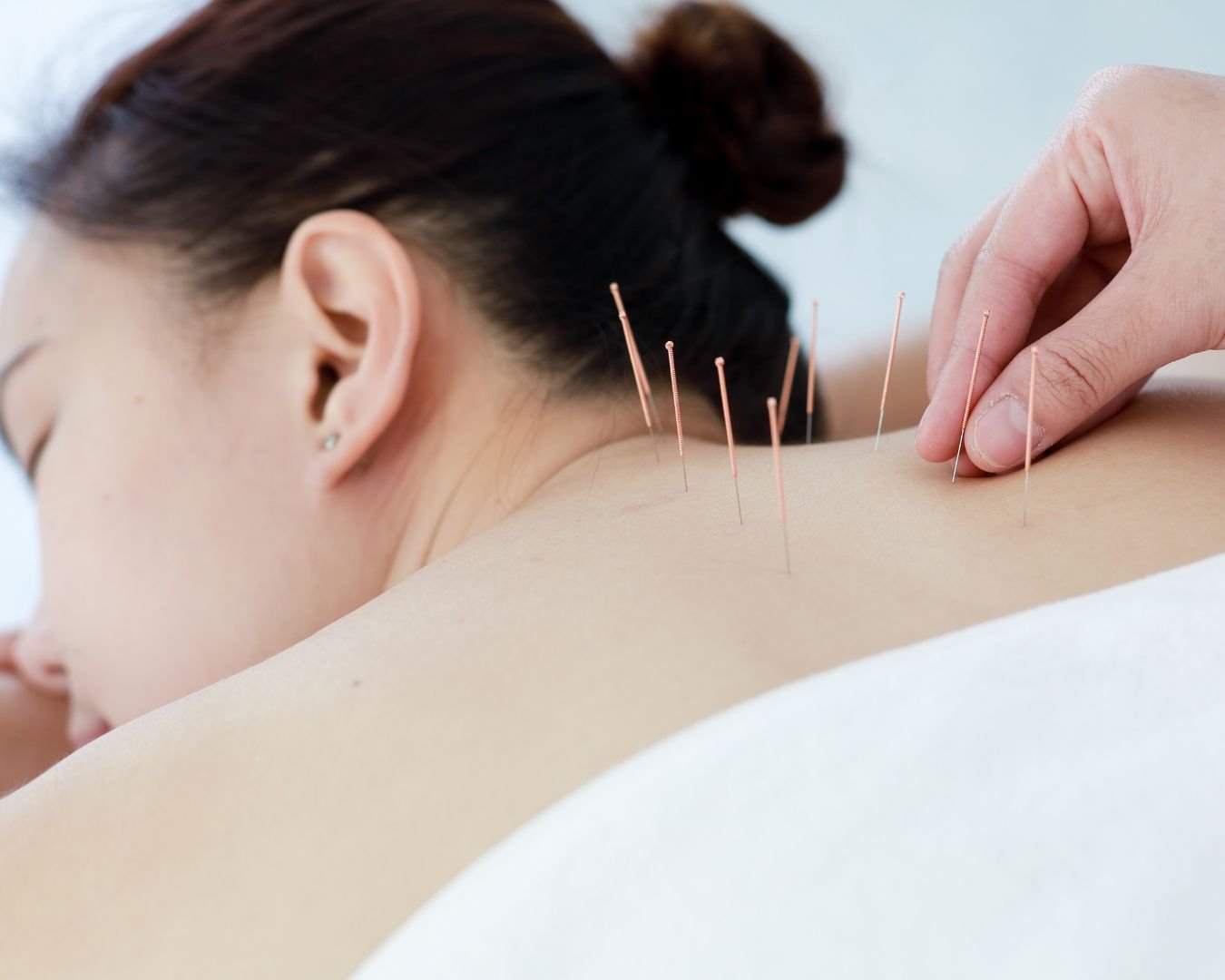 O que é acupuntura, e como ela ajuda a tratar várias doenças
